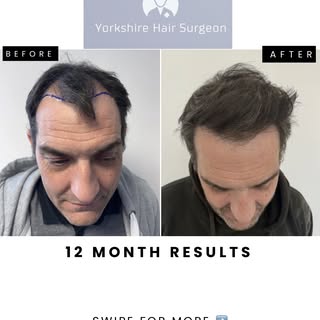 12 months post hair transplant result.

~2000 grafts

Every case is carefully planned and performed 