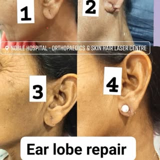 #earloberepair #earpiercing #dermatologist #dermatosurgery #cosmetologist #drbhumi #southbopalahmeda