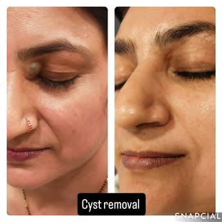 #cystremoval #sebaceouscystremoval #dermatosurgery #dermatologist #cosmetologist #drbhumi
