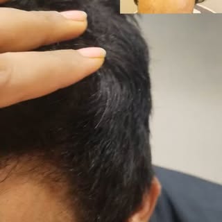 To give satisfactory result is our identity....happy patient....blessed me...😊🙏
#hairtransplantres