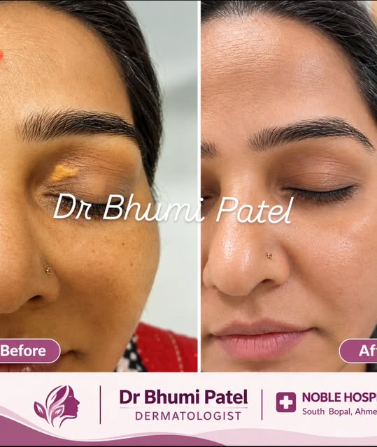 👁️ YELLOW PATCHES AROUND YOUR EYES? IT COULD BE XANTHELASMA!

Have you noticed yellowish, soft patc
