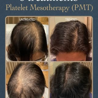 Your hair deserves the best and most natural treatment.

Platelet Mesotherapy nourishes your scalp, 