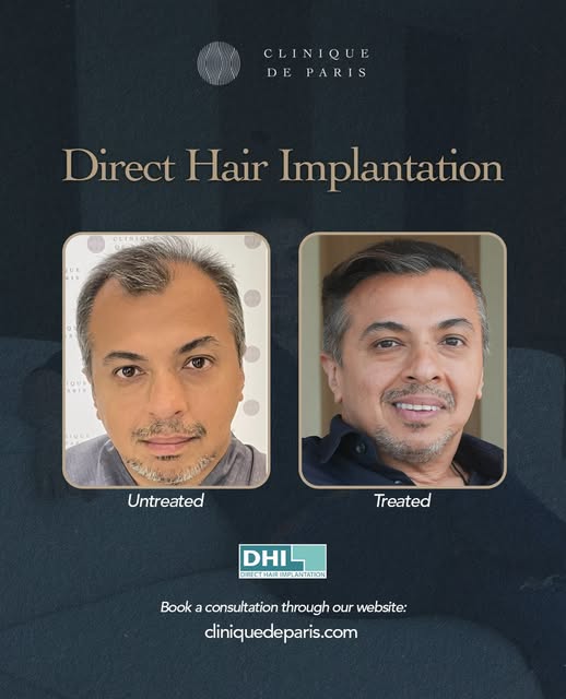 Mahesh (@mpmirpuri ) came in with concerns around his receding hairline and thinning crown.

He was 