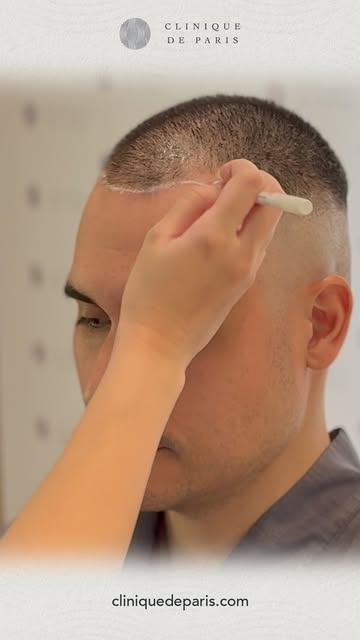 Hair restoration, defined by precision.

For over a decade, Clinique de Paris has welcomed patients 
