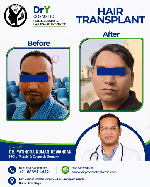 🌿 Hair Transplant Before & After | Natural-Looking Hair Restoration

✨ Realistic Hair Restoration. 