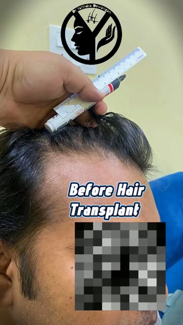 Hair Transplant in Raipur | Advanced Hair Restoration | Before & After | Dr. Yatindra Dewangan Raipu