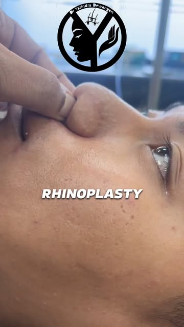 SEG Graft Rhinoplasty in Raipur | Nose Reshaping & Structural Support | Dr. Yatindra Dewangan #reels