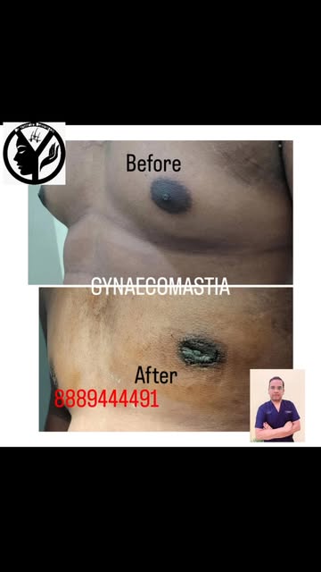 Gynecomastia Surgery in Raipur | Male Breast Reduction | Dr. Yatindra Dewangan

Gynecomastia surgery