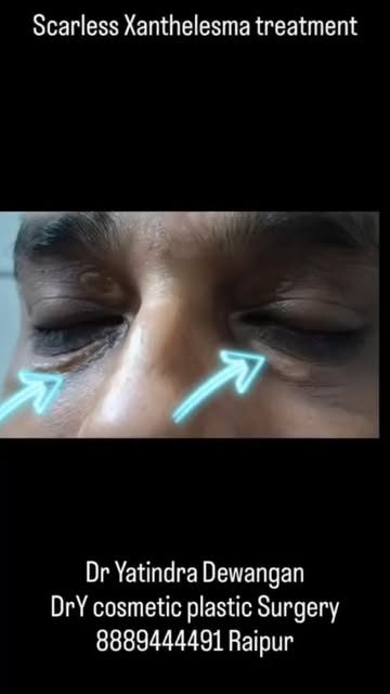 Xanthelasma Excision Surgery in Raipur | Eyelid Lesion Removal | Dr. Yatindra Dewangan

Xanthelasma 