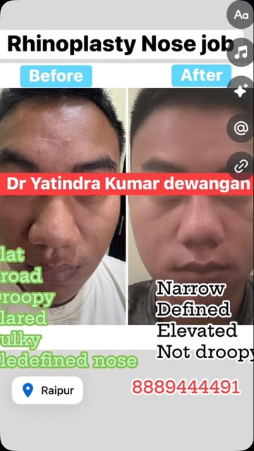 ✨ Rhinoplasty (Nose Job) – 7-Day Follow-Up | Rhinoplasty | Early Post-Operative Result at 7 Days

A 