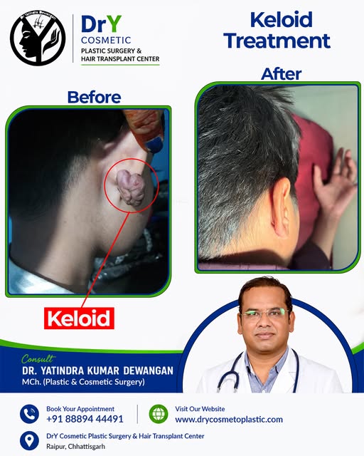 🩺 Keloid Surgery – Advanced Scar Management

Keloids are raised, firm scars that can grow beyond th
