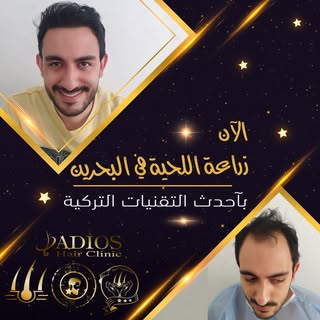 نتيجة زراعة الشعر قبل و بعد لاحد مرضانا على مدار سنة كاملة بالصور على شكل سلايد 
الخبرة التركية الان