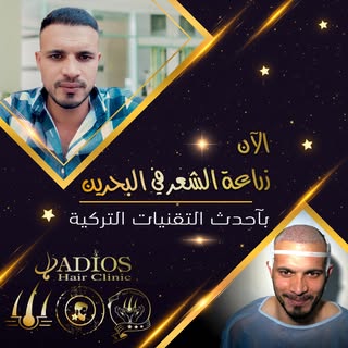 نتيجة زراعة الشعر قبل و بعد لاحد مرضانا على مدار سنة كاملة بالصور على شكل سلايد 
الخبرة التركية الان