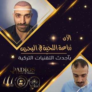 نتيجة زراعة الشعر قبل و بعد لاحد مرضانا على مدار 6 أشهر كاملة بالصور على شكل سلايد 
الخبرة التركية ا