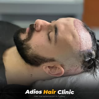 Painless hair transplantation in Turkey
We stand out from the rest
100% guaranteed results for life
