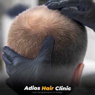 Painless hair transplantation in Turkey
We stand out from the rest
100% guaranteed results for life
