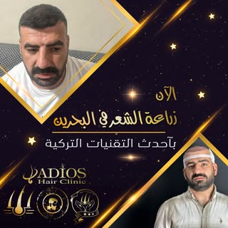 نتيجة زراعة الشعر قبل و بعد لاحد مرضانا على مدار سنة كاملة بالصور على شكل سلايد 
الخبرة التركية الان