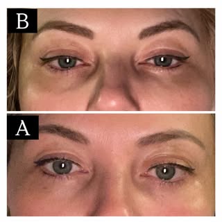 BEFORE & AFTER POLYNUCLEOTIDES EYE:

A lovely London patient brought in her own before & after photo