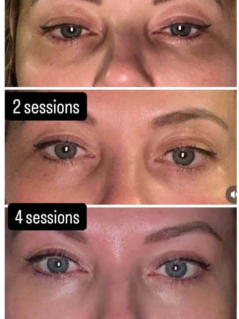 POLYNUCLEOTIDES EYES:

Thank you to my London patient for monitoring her progress by taking self pho