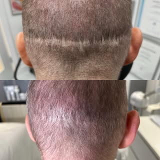A recent favourite of mine! One of my clients healed result of a scar cover up I did via scalp Micro