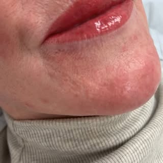Freshly topped up lips, some swelling but will subside quickly 💋

#lipblushtattoo #lipblush #juicyl