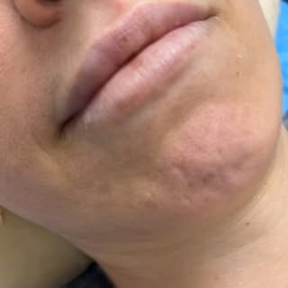 Lips be blushing ❤️

#lipblush #liptattoo #lips #permanentmakeup #spmulips