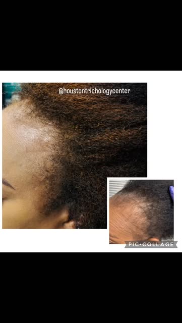 A complete year’s transformation @houstontrichologycenter 🤩 
She listened to my recommendation, con