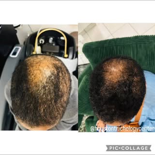 What a difference 6 weeks can make😳

Book your consultation @houstontrichologycenter 901-293-0506


