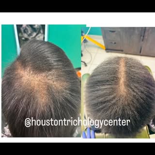 Transformation here @houstontrichologycenter 

✨ @houstontrichologycenter HTC shampoo and conditione