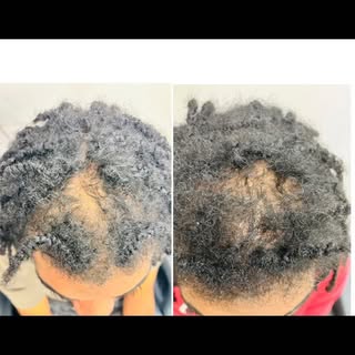 Male pattern baldness? Here’s growth  in just 6 weeks 😲

Have you booked your consultation with @ho