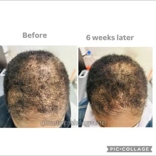 6 week transformation 😲 @houstontrichologycenter 

✨HTC Shampoo and Conditioner was used for each s