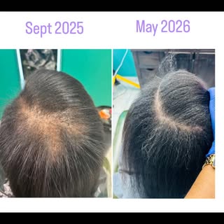 Sept 2025 ➡️ May 2025

Real results and thicker hair @houstontrichologycenter 

📲 901-293-0506
www.