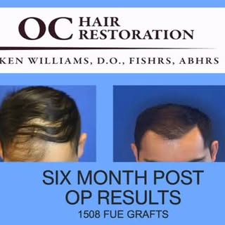 Dr. Williams demonstrates a six month post operative FUE result in a male with hair loss. #hairbywil