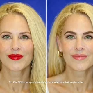The art and science of eyebrow restoration using surgical techniques. Dr. Williams performs eyebrow 