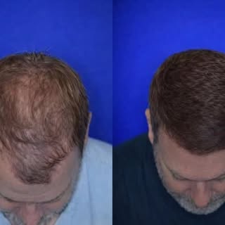 It’s not just hair… it’s confidence.#hairtransplant #hairlinedesign #hairrestoration #fuehairtranspl