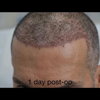 #prp #cosmetics#hairlinedesign #hairrestoration #fuehairtransplant Disclaimer: to protect patient pr