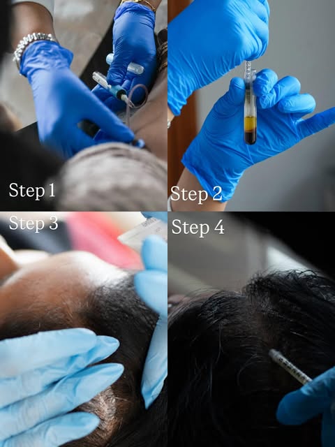 4 Simple Steps to Hair Regeneration ✨ 

Step 1: A small amount of blood is drawn from your arm, just