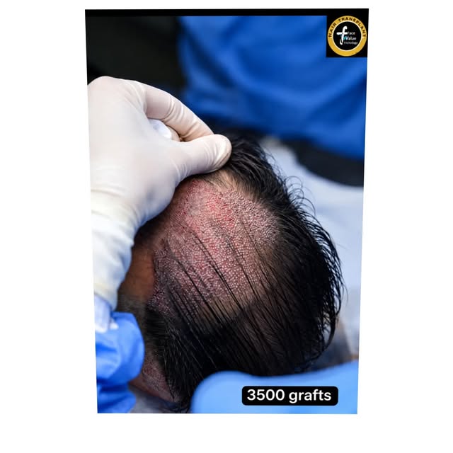 She Lost Most of Her Front Hair at Just 37.

Sherlin from Delhi was experiencing Female Androgenetic