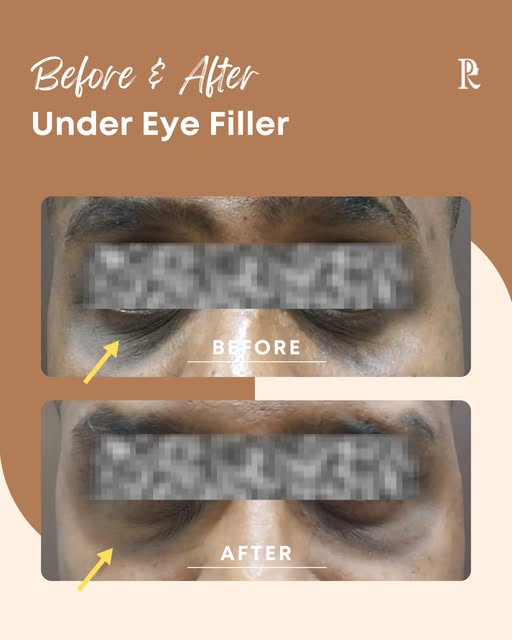 A refreshed look with a subtle difference. ✨

This patient came to Peters Radiant Clinic with concer