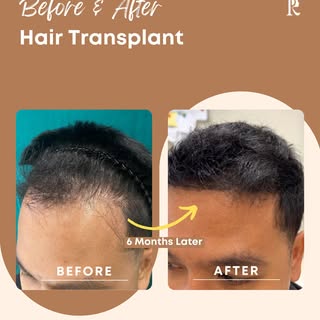 Look at this impressive hair transformation! 😍

This patient presented with hair thinning and an M-