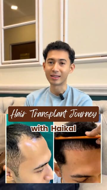 From an M-shaped hairline to a fuller-looking hairline. ✨

Haikal came to Peters Radiant Clinic with