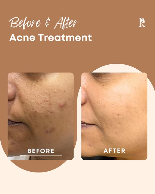 A clearer, healthier-looking complexion takes the right approach. 🤎

This patient came to Peters Ra