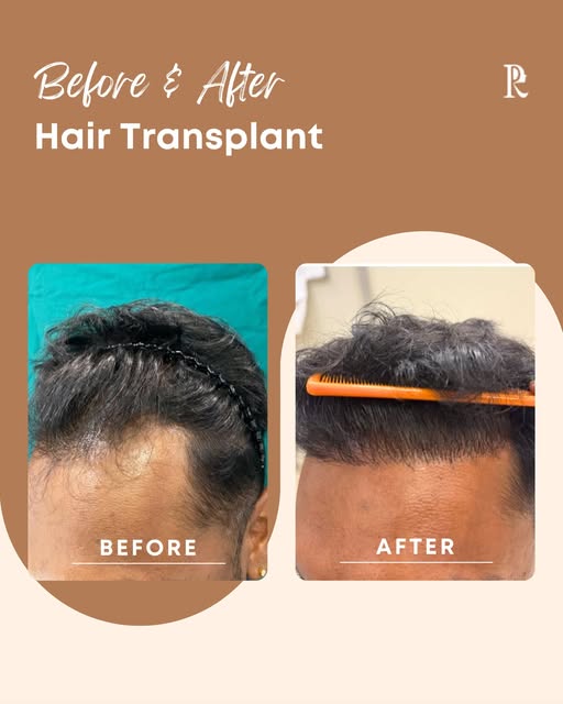 A fuller, more natural-looking hairline can make a big difference. ✨

This patient came to Peters Ra
