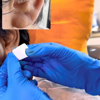 Ear Piercing - @dr.shalusavla_gala 

#earlobepiercing #earloberepair #beforeandafter #proceduresdone
