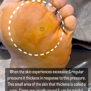 CORN REMOVAL @dr.shalusavla_gala 

#cornremoval #cornprevention #drshalusavla_gala #khar #lowerparel