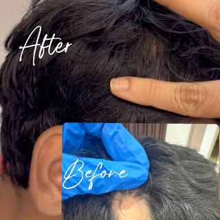Alopecia Areata before & after @dr.shalusavla_gala 

#alopeciaareata #beforeandafter #intralesionals
