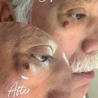 Cyst Removal @dr.shalusavla_gala 

#drshalusavla_gala #cystremovaltreatment #beforeafter #painlessre