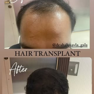HAIR TRANSPLANT 

If you are experiencing hair loss or hair thinning, there are treatments available
