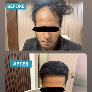 Alopecia Areata before and after @dr.shalusavla_gala 

#drshalusavla_gala #alopeciatreatment #alopec