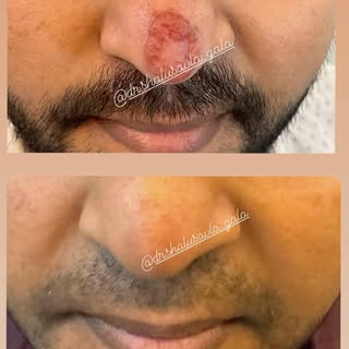 LUPUS VULGARIS BEFORE & AFTER @dr.shalusavla_gala 

#drshalusavla_gala #lupusvulgaris #beforeandafte